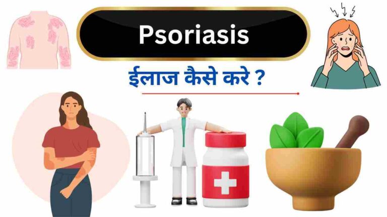 psoriasis ka ilaj kaise kare