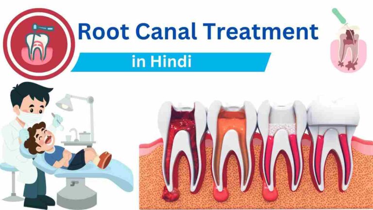 Root Canal Treatment in Hindi