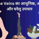 varicose veins treatment upchar yoga in Hindi