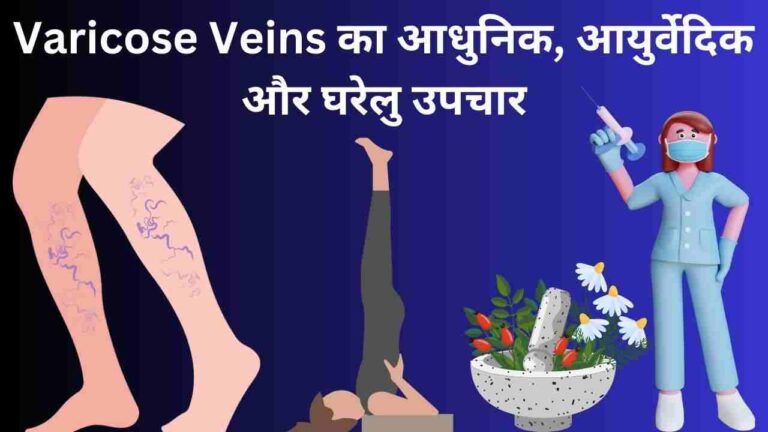 varicose veins treatment upchar yoga in Hindi