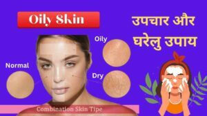 Oily Skin का उपचार और घरेलु उपाय