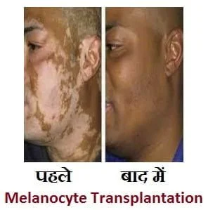 Melanocyte-Transplantation-in-hindi