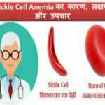 sickle-cell-anemia-symptoms-causes-treatment-hindi