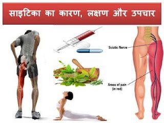 sciatica-symptoms-treatment-in-hindi