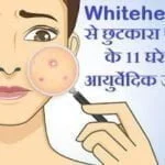 whiteheads-remedies-in-hindi.html