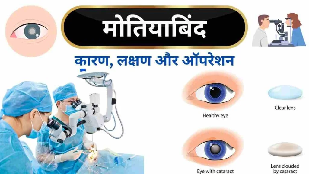 Cataract motiyabind causes symptoms treatment in Hindi