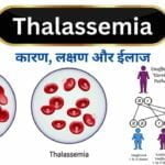 Thalassemia का कारण, लक्षण, निदान, एहतियात और ईलाज