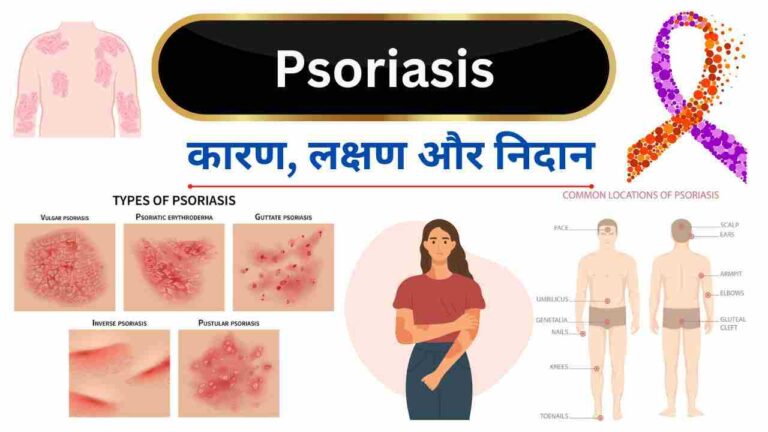 psoriasis ka karan aur lakshan kya hain in Hindi
