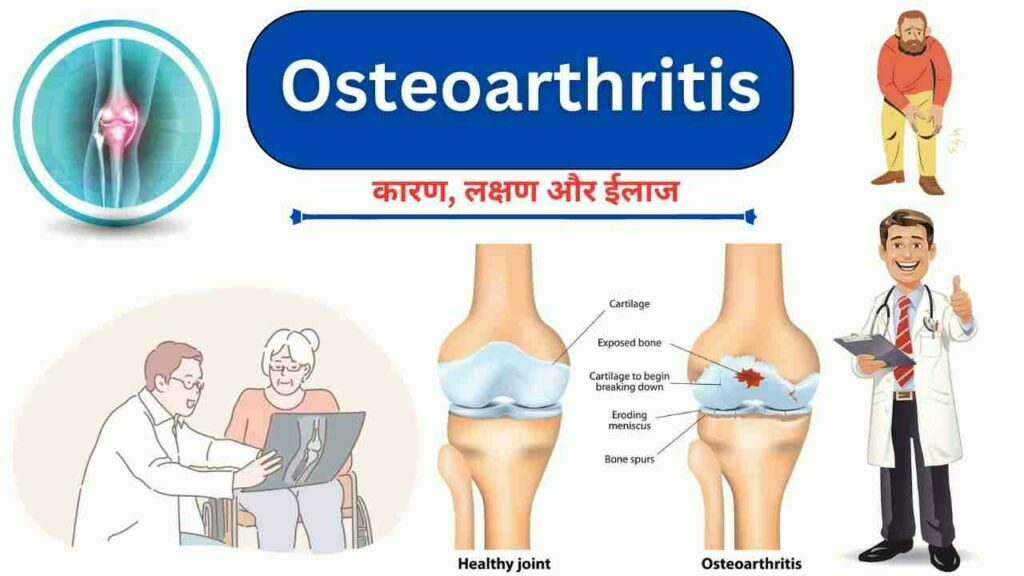 Osteoarthritis causes symptoms treatment diet in Hindi