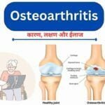 Osteoarthritis causes symptoms treatment diet in Hindi