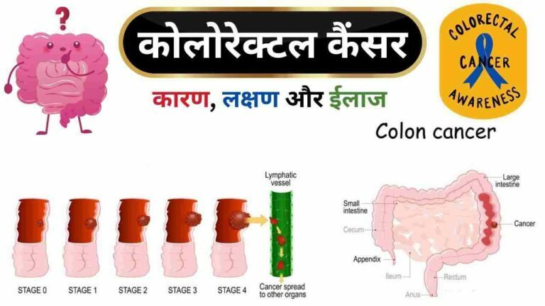 colorectal cancer stages symptoms treatment in Hindi