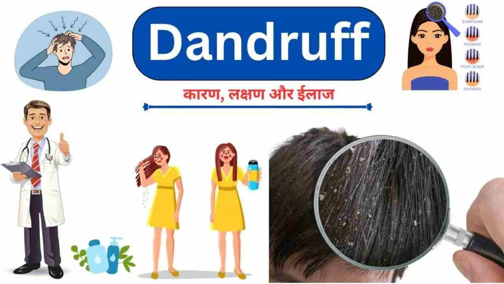dandruff causes treatment home remedies in Hindi