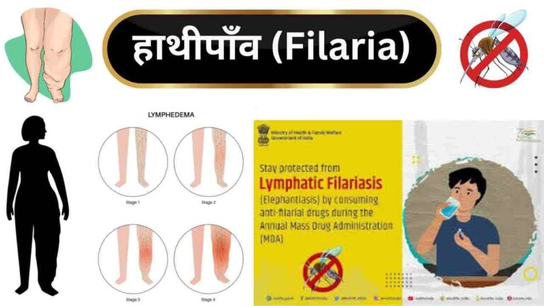 filaria causes symtpoms treatment in Hindi
