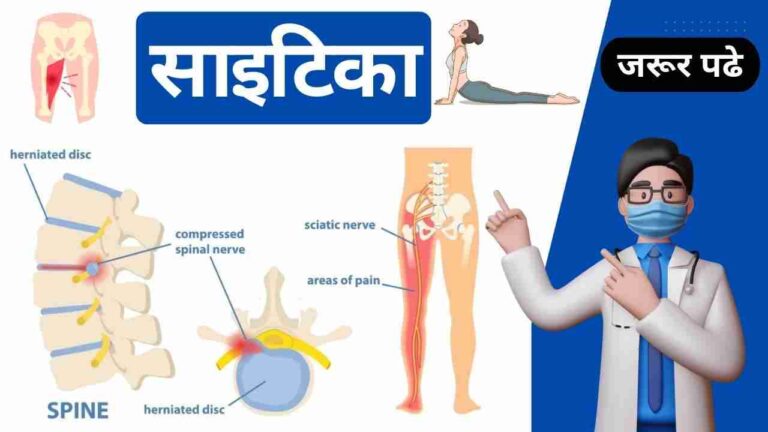 sciatica causes symptoms treatment in Hindi