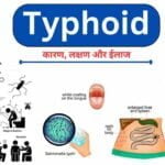 typhoid causes symptoms treatment home remedies in Hindi