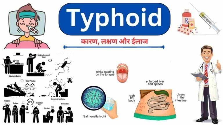 typhoid causes symptoms treatment home remedies in Hindi