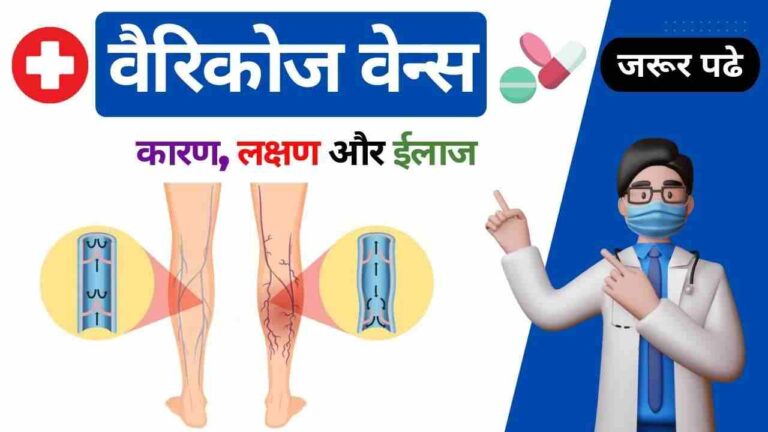 varicose veins causes symptoms treatment in Hindi
