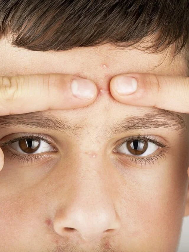 whitehead pimple treatment Home remedies Hindi