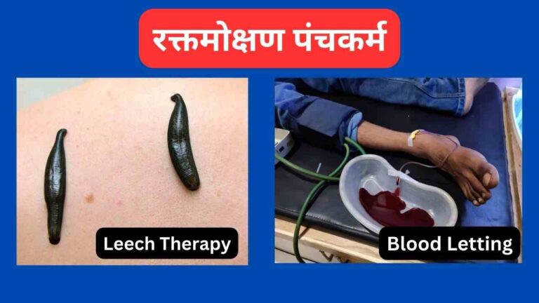 raktamokshana panchkarma leech therapy benefits in Hindi