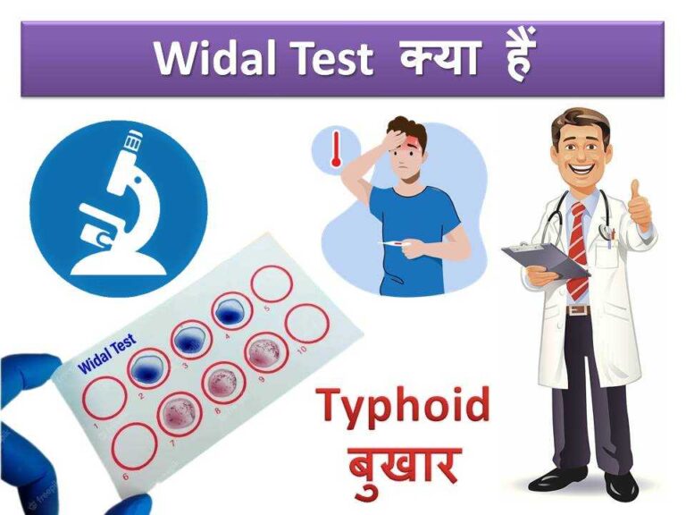 Widal test Typhoid in Hindi