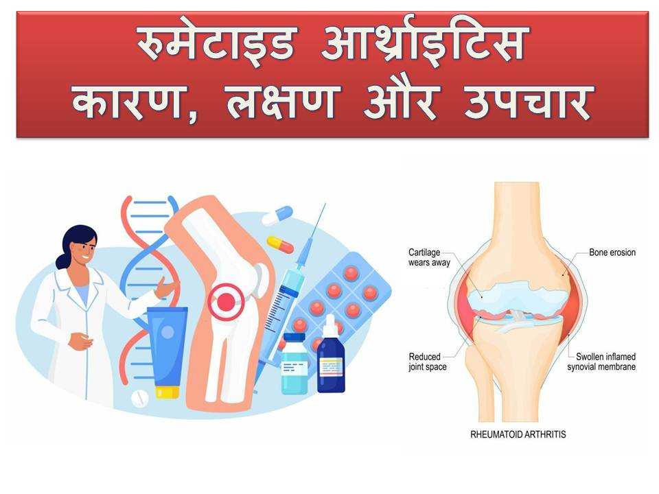 Rheumatoid Arthritis causes symptoms treatment in Hindi